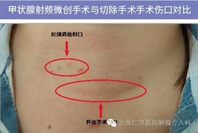 美康生物获得发明专利授权：“一种刺激性促甲状腺激素受体抗体亚型检测试剂盒及其制备方法与应用”