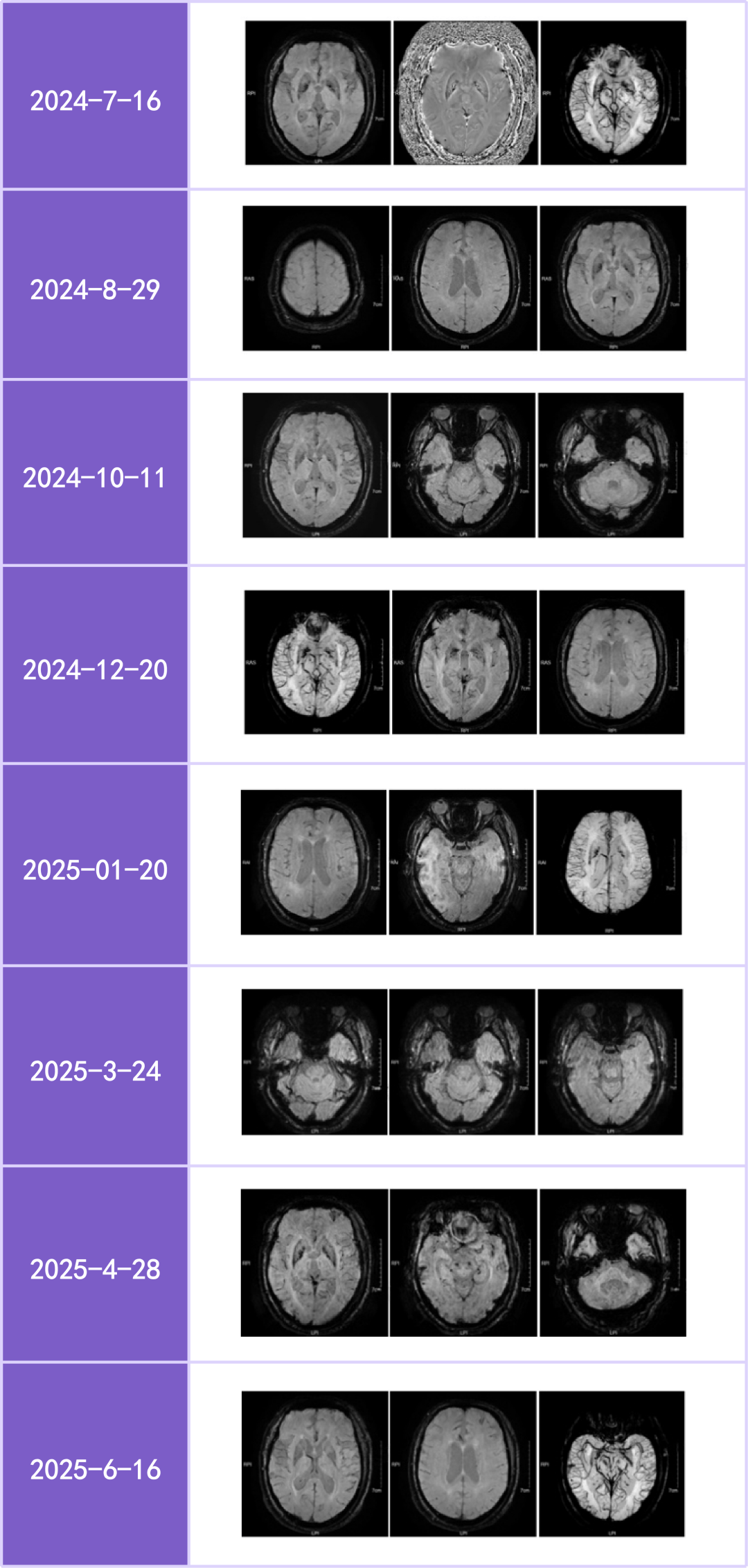 热景生物：参股公司创新药AA001单抗Ib期临床研究完成首例阿尔茨海默病受试者入组给药